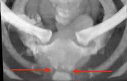 Osteomyelitis of Sternomanubrial Joint - CTisus CT Scan