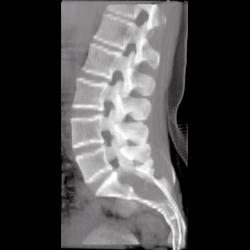 Marfan Syndrome - CTisus CT Scan