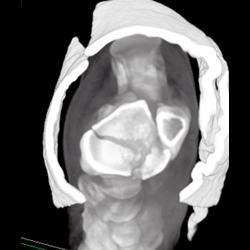 Tibial Fracture - CTisus CT Scan