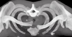 Sternoclavicular Joint (SC Joint) Dislocation - CTisus CT Scan