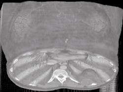 Neurofibromatosis - CTisus CT Scan