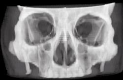 Zygomatic Arch Fracture - CTisus CT Scan