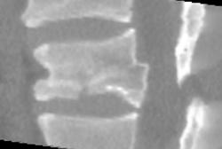 Compression Fracture - CTisus CT Scan