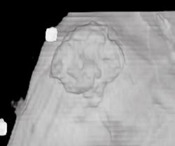 Ulcerating Skin Lesion - CTisus CT Scan