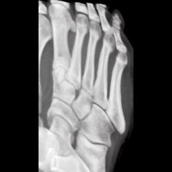 Normal Tarsal Bones - Musculoskeletal Case Studies - CTisus CT Scanning