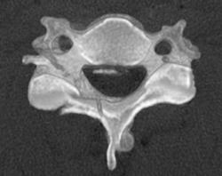 Cervical Spine Fracture - CTisus CT Scan