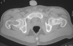 Aneurysmal Bone Cyst (ABC) of Femur - CTisus CT Scan