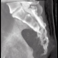 Destruction of Sacrum By Recurrent Rectal Cancer - CTisus CT Scan