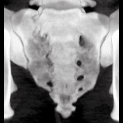 Sacral Fracture - CTisus CT Scan