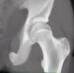 Posterior Acetabular Fracture - CTisus CT Scan