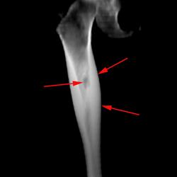 Osteoid Osteoma - CTisus CT Scan