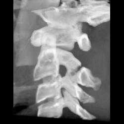 Hangman's Fracture - CTisus CT Scan