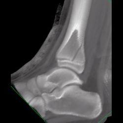 Distal Tibial Fracture - CTisus CT Scan