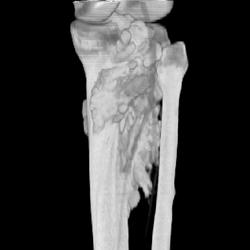 Parosteal Osteosarcoma - CTisus CT Scan