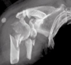 Fracture of Humerus - CTisus CT Scan