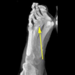 Foreign Body- Glass - CTisus CT Scan