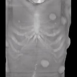 Cysts in Pt With Gardners Syndrome - CTisus CT Scan