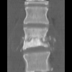 MVA With L-spine Fracture - CTisus CT Scan