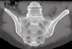 Infection Right SI Joint - CTisus CT Scan