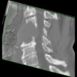 Metastasis Spine From Renal Cell Carcinoma - CTisus CT Scan