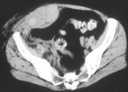 Rectus Bleed - CTisus CT Scan