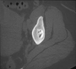 Benign Cortical Lesion - CTisus CT Scan