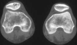 Sarcoidosis - CTisus CT Scan