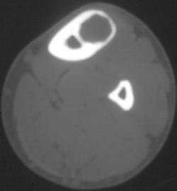 Bone Cyst - CTisus CT Scan