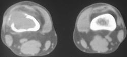 Giant Cell Tumor - CTisus CT Scan