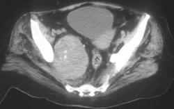 Neurogenic Tumor - CTisus CT Scan