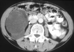 Liposarcoma - CTisus CT Scan