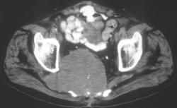 Neurogenic Sarcoma - CTisus CT Scan