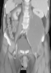 Psoas Abscess - CTisus CT Scan