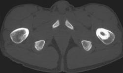 Osteoid Osteoma - CTisus CT Scan