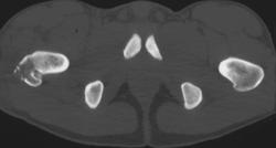 Femur Fracture - CTisus CT Scan