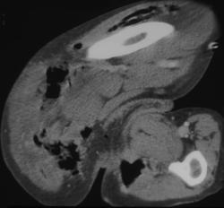 Necrotizing Fasciitis - CTisus CT Scan