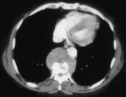 Osteomyelitis - CTisus CT Scan