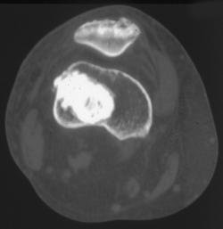 Atypical Osteoid Osteoma - CTisus CT Scan