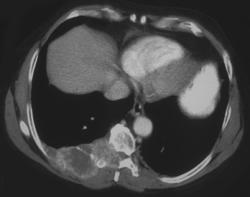 Metastases to the Chest Wall - CTisus CT Scan