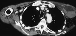 Hematoma in Left Axilla - CTisus CT Scan