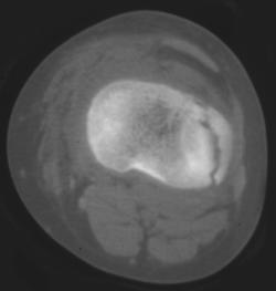 Tibial Plateau Fracture - CTisus CT Scan