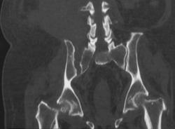 Pelvic Fractures With Right Si Diastasis - CTisus CT Scan