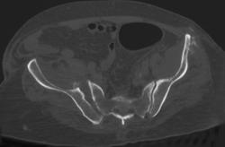 Fracture and Diastasis of the Right SI Joint - CTisus CT Scan