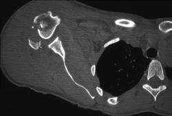 Humerus Fracture - CTisus CT Scan