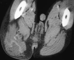 Gluteal Abscess - CTisus CT Scan