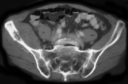 Thyroid Metastases to Iliac Wing - CTisus CT Scan