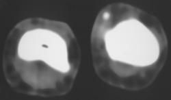 Foreign Body - CTisus CT Scan