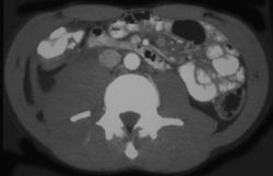 Fracture of Transverse Process of L3 With Hematoma - CTisus CT Scan