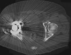 Total Hip Replacement (THR) With Reduced Artifact on Reconstructed Views - CTisus CT Scan