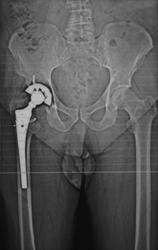 Metal Artifact on Axial Ct - CTisus CT Scan